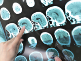 Intervención endoscópica es efectiva para la hidrocefalia
