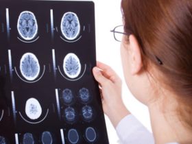 Alarminas secretadas tras un ictus promueven la aterosclerosis