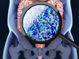 Microbioma del páncreas tumoral: motor de la oncogénesis