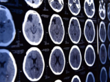 Diabetes y tabaquismo promueven calcificación del hipocampo