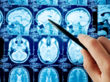 Células dendríticas benefician a pacientes con glioblastoma