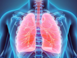 Antibióticos para la exacerbación en bronquiectasia