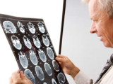 Poliovirus como tratamiento del glioblastoma