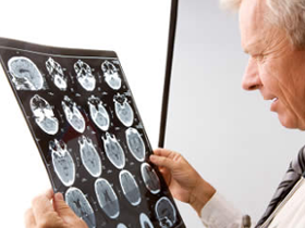 Poliovirus como tratamiento del glioblastoma