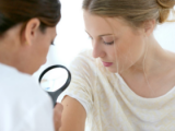 Melanoma: prevención, detección y tratamiento