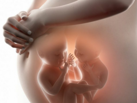 Impacto de la diabetes gestacional en el embarazo múltiple