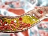 Sueño insuficiente eleva el riesgo de aterosclerosis