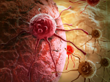 ADN circulante predice resultados en cáncer pancreático