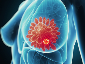 Trastuzumab biosimilar es efectivo en la metástasis