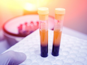 Neurofilamentos séricos posibilitan detección de alzhéimer hereditario