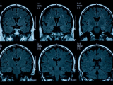 Factores de riesgo cardiovascular se asocian con peor salud cerebral