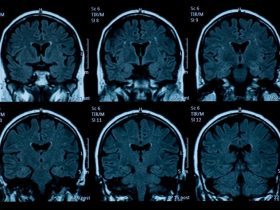 Factores de riesgo cardiovascular se asocian con peor salud cerebral