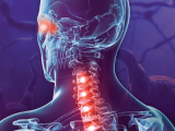 Eculizumab atenúa prolapso de trastorno del espectro NMO