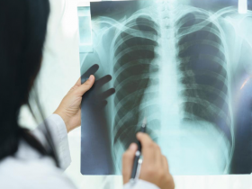 Nintedanib beneficia a pacientes con EPI