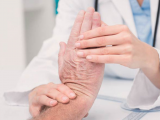 Etanercept es superior a MTX en la artritis psoriásica 