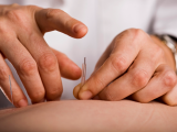 Acupuntura beneficia a pacientes en terapia antianginosa