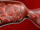 Anticoagulantes como profilaxis primaria contra la TEV