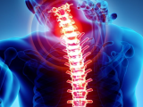 Fusión cervical posterior mejora desenlaces clínicos 
