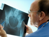 Fractura de cadera: ¿hemiartroplastia o artroplastia total?