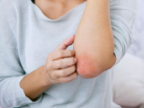 Ligelizumab es eficaz para la urticaria espontánea crónica