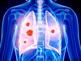 Terapia biológica dual para cáncer de pulmón no microcítico