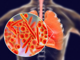 Microbiota se asocia diferencialmente con exacerbación asmática