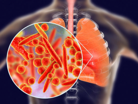 Microbiota se asocia diferencialmente con exacerbación asmática