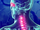 Satralizumab reduce riesgo de recaída en neuromielitis óptica