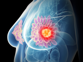 TNF-α exhibe un rol dual en el cáncer de mama