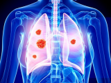 Pembrolizumab más quimioterapia contra el cáncer