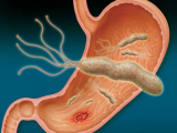 Lactobacillus reuteri como terapia de erradicación