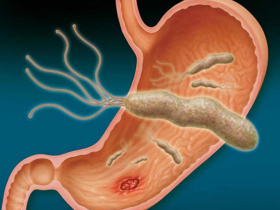 Lactobacillus reuteri como terapia de erradicación