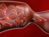 Apixabán es útil frente al TEV asociado al cáncer