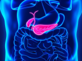 Diabetes como manifestación del cáncer de páncreas