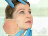 Deep learning asiste el diagnóstico dermatológico