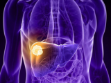 Terapia biológica extiende sobrevida en hepatocarcinoma