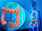 Upadacitinib logra remisión en colitis ulcerosa