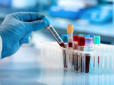 ADN tumoral metilado permite detección precoz del cáncer 