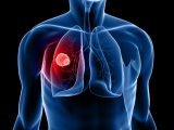 Exploración por TC mitiga mortalidad en cáncer de pulmón 