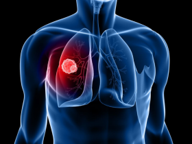 Exploración por TC mitiga mortalidad en cáncer de pulmón 