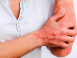 C-Jun, una nueva diana en la psoriasis