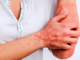 C-Jun, una nueva diana en la psoriasis