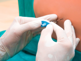 Anestesia epidural en parto segura frente al TEA