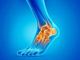 Plasma rico en plaquetas en la osteoartritis de tobillo