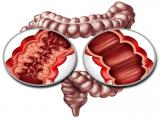 Atorvastatina puede ser un tratamiento eficaz para la colitis ulcerosa 