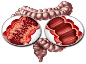 Atorvastatina puede ser un tratamiento eficaz para la colitis ulcerosa 