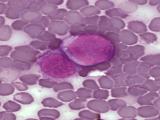 Identifican factores de riesgo genético para la leucemia 