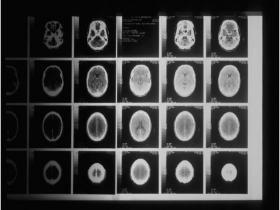 Asma reduce la incidencia de tumores cerebrales 