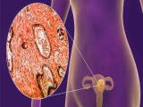 Terapia experimental para el cáncer de endometrio avanzado