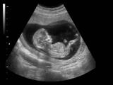  Ultrasonido prenatal puede identificar signos de autismo 